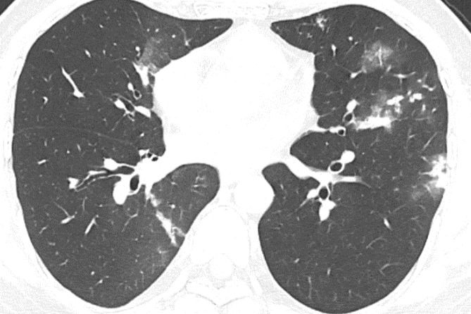 Hình ảnh đông đặc và nốt mờ hai phổi trên phim chụp CT của bệnh nhân.