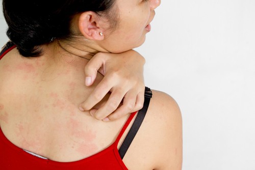 Kết quả hình ảnh cho trị dị ứng hải sản